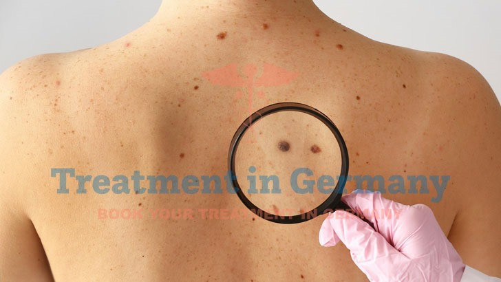 Advanced Skin Cancer Treatment in Germany