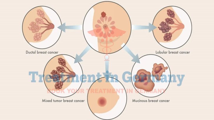 The Main Types of Breast Cancer Treatment in Germany