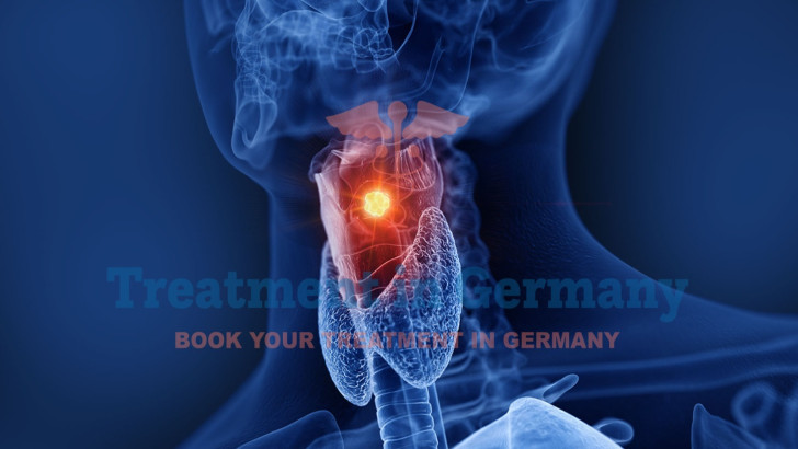 Throat Cancer Treatment in Germany: Advanced Options and Innovative Therapies