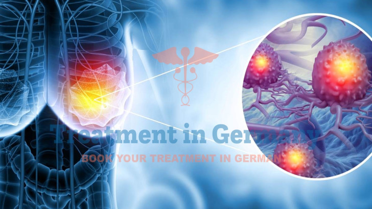 Advanced Treatment Options for Metastatic Breast Cancer in Germany