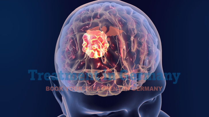 Latest Brain Cancer Treatment Options in Germany