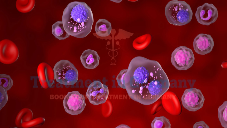 Can Dendritic Cell Therapy Enhance Multiple Myeloma Outcomes in Germany?
