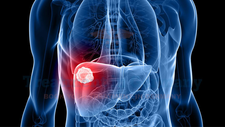 TACE for Liver Cancer in Germany