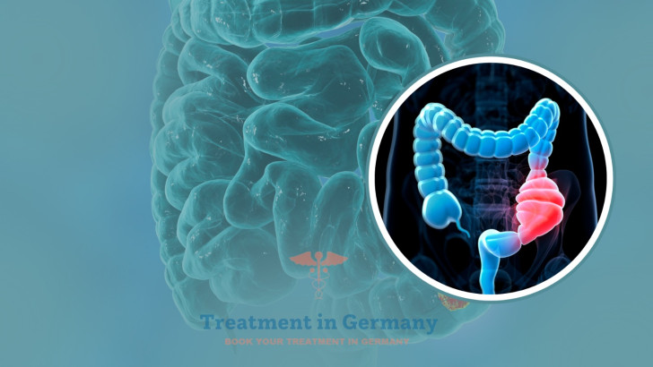 Colon Cancer Treatment Options in Germany