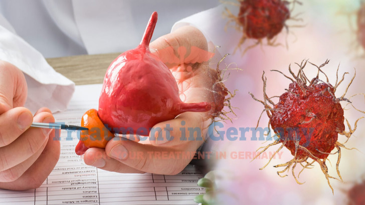 Prostate Cancer Treatment with Dendritic Cells in Germany