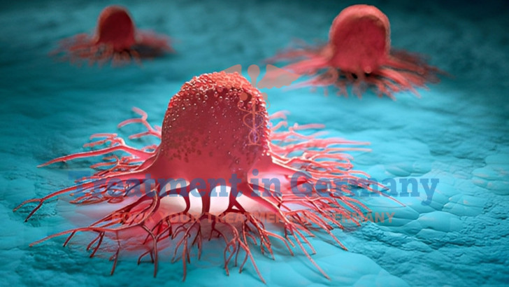 TACE Treatment for Stage 4 Neuroendocrine Tumors in Germany