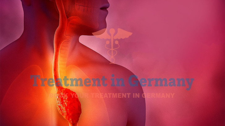Esophageal Cancer: Treatment in Germany