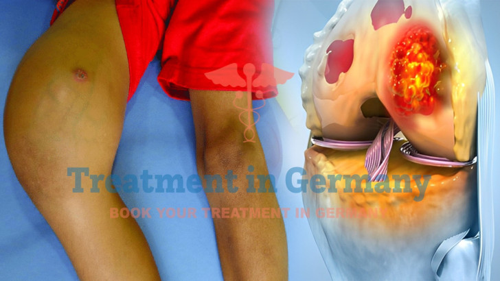 Dendritic Cell Therapy for Osteosarcoma Patients in Germany
