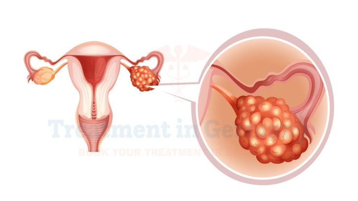 Advanced Stage 4 Ovarian Cancer Treatments in Germany