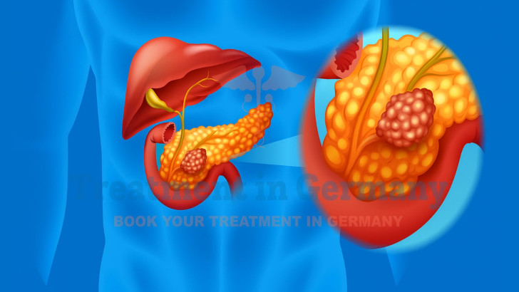 Pancreatic Cancer Symptoms and Treatment with Dendritic Cell Therapy in Germany