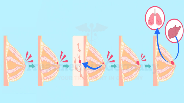 Breast Cancer Stages: Treatment Stage by Stage
