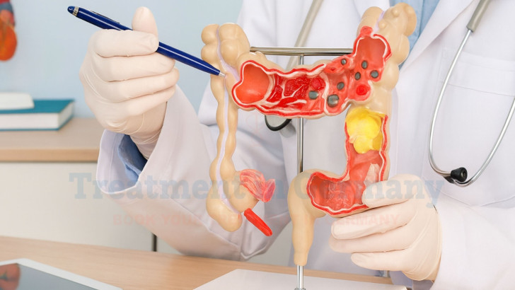 What Are the Survival Rates for Stage 3 Colon Cancer?