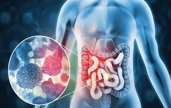 Stage 4 Colon Cancer Treatment in Germany