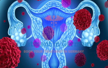 Advanced Ovarian Cancer Treatment in Germany