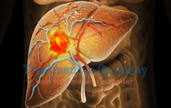Advanced Liver Cancer Stage 4 Treatment in Germany