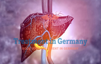 Liver Cancer Treatment in Germany
