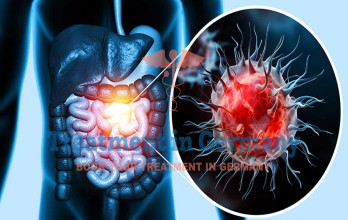 Advanced Colon Cancer Treatment with Dendritic Cell Therapy in Germany