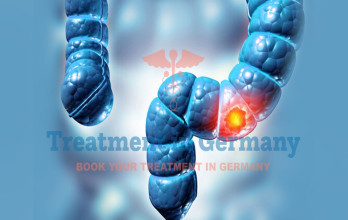 Colon Cancer Treatment in Germany: Advances in Surgery, Chemotherapy, and Dendritic Cell Therapy