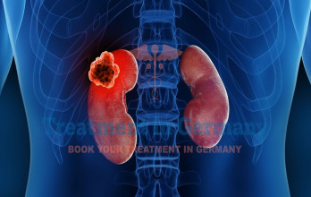 Renal Cell Carcinoma: Diagnosis and Management in Germany