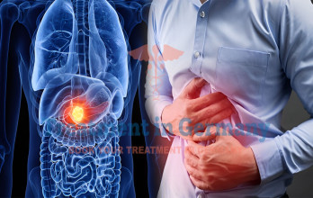 Modern Treatments for Pancreatic Cancer in Germany
