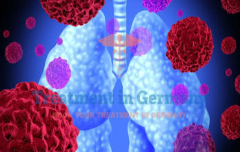 Is Dendritic Cell Therapy Effective for Non-Small Cell Lung Cancer?