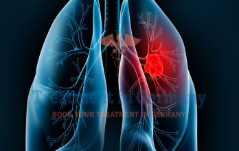 Lung Cancer: Expanding Treatment Options with Dendritic Cell Immunotherapy in Germany