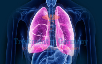 Pulmonary Fibrosis: Exploring New Treatment Options with Dendritic Cell Therapy in Germany