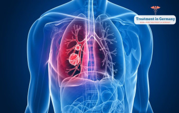 Kidney Cancer: Breakthroughs in Renal Cell Carcinoma Therapy with Dendritic Cell Immunotherapy in Germany