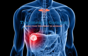 Advanced Stage 4 Liver Cancer Treatment in Germany