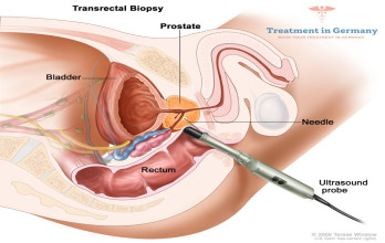 Prostate Cancer Treatments Available in Germany: A Beacon of Hope for Cancer Patients