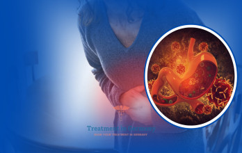 Treatment of Stage 4 Stomach Cancer in Germany