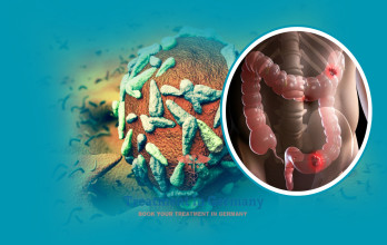 Stage 4 Rectal Cancer Treatment Options in Germany