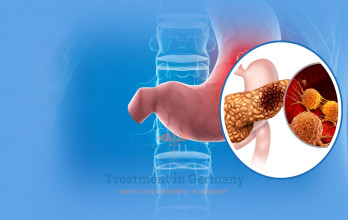 Targeted Therapy for HER2-Positive Stomach Cancer in Germany