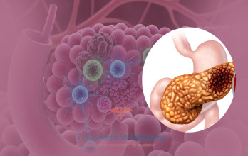 Pancreatic Cancer Treatment Options in Germany