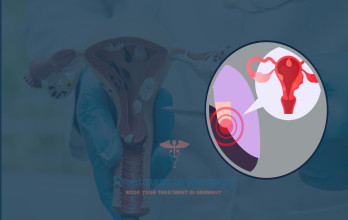 Ovarian Cancer Treatment Options in Germany