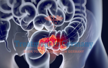 Colorectal Adenocarcinoma Treatment Options in Germany