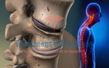 Scheuermann's Disease Treatment in Germany