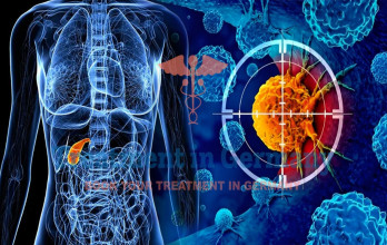 Dendritic Cell Therapy for Gallbladder Cancer in Germany