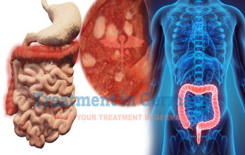 Ulcerative Colitis Treatment in Germany
