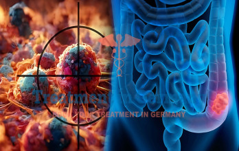Groundbreaking Progress in Targeted Therapy for Colorectal Cancer in Germany