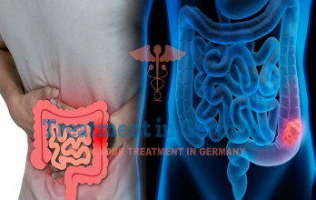 Stage 4 Colon Cancer: Germany’s Comprehensive Approach to 4-Stage Bowel Cancer Treatment