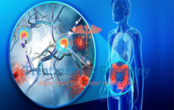 Dendritic Cell Immunotherapy for Colon Cancer in Germany