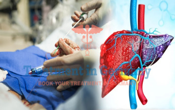 5 Benefits of TACE Therapy for Cancer Patients in Germany