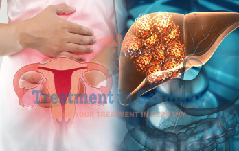 TACE Treatment for Stage 4 Ovarian Cancer with Liver Metastases in Germany
