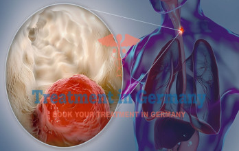 TACE Treatment for Esophageal Cancer Patients in Germany