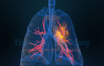 Transpulmonary Chemoembolization (TPCE) treatment in Germany