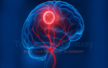 Brain cancer Symptoms and Treatment in Germany