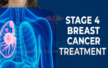 Stage 4 Breast Cancer treatment Options in Germany