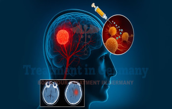 Dendritic Cell Therapy for Glioblastoma in Germany