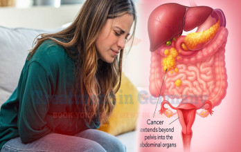 Stage 3 Ovarian Cancer Treatment Options in Germany